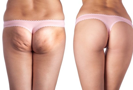 Creme para a celulite